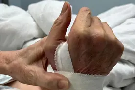 术后患者自行按压切口即可止血，脑梗治疗有了一条新“入”路图片