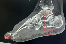 男子足跟粉碎性骨折，乱用土办法治疗再添新伤图片