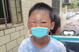 一觉醒来，11岁男童为何变成了“猪猪侠”？图片