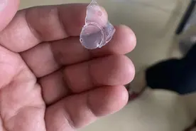 女子喝奶茶后突感胸口疼，就医发现竟吞下塑料杯盖碎片！医生提醒图片