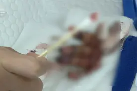 揪心！云南1岁半宝宝4根手指被切成7段……图片