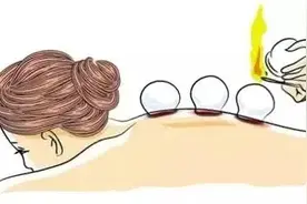 拔火罐“引火烧身”，该如何赔偿？图片