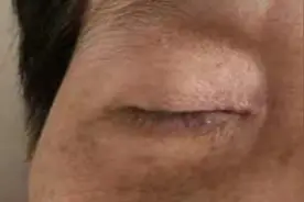 杭州女子右眼突然睁不开 医生：视力下降者要警惕痛性眼肌麻痹图片