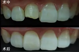 女子门牙意外撞折缺损一部分，贴面修复还原外貌图片