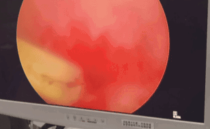 惊呆了！杭州46岁男子尿道“掉进”小拇指长蒜苔，医院：怎么进去的，他没回答图片