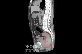 男子将18厘米异物塞入体内无法取出 导致直肠出血不止急就医图片