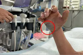 48小时内可致死！男子洗锅被钢丝球扎伤手，送进ICU才抢回一命……图片