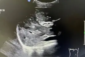 24岁妈妈确诊肝癌晚期崩溃痛哭，孩子才3岁！医生叹息，3年前就有症状图片