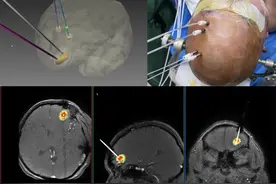 国内首例！齐鲁医院成功开展脑胶质瘤机器人活检和激光消融术图片