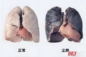 科普 | 尘埃下的呼吸刺客——尘肺病图片