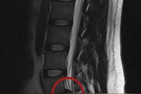 22岁男生打游戏久坐竟腰椎间盘突出！专家：腰突不是中老年人“专利”图片