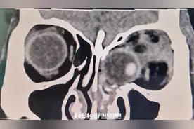 贵州一女子从3楼坠落眼球掉进鼻子！医院紧急手术复位眼球保住视力图片