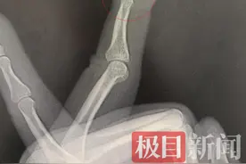 男子打篮球戳伤手指，几天后手指肿成“小锤”图片