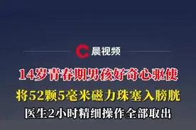 14岁青春期男孩受好奇心驱使，将52颗5毫米磁力珠塞入膀胱，医生精细操作全部取出图片