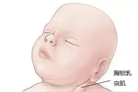 宝宝“歪头杀”？警惕小儿斜颈！图片