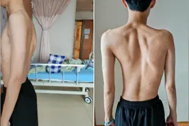 重塑脊梁，青春启航：青少年特发性脊柱侧弯矫正手术图片