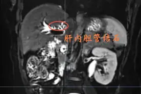 胆囊切除十年后竟又遭遇胆结石！医生提醒：胆囊切除并非一劳永逸，日常生活仍需注意图片