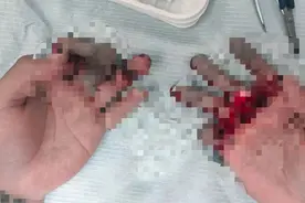 从绝望到欣慰，医生妙手让小伙七根断指全部“复活”图片