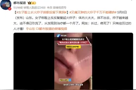 女子脸上长火疖子排脓后留下黑洞 网友：只有经历过的人才懂图片