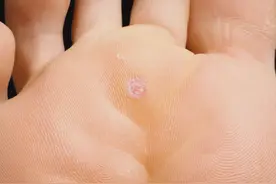 身上这种“小疙瘩”会传染，千万别乱抠！图片