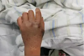 露营遇蛇咬伤！春暖蛇出洞，踏青赏花这样防蛇图片