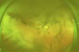 世界糖尿病日｜黑影浮动险失明，医生提醒：远离“甜蜜陷阱”图片