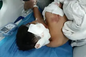10岁男童遭阿拉斯加犬咬伤，事发第三天仍在ICU病房内救治图片