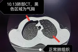 睡个觉居然肺“炸了”！这种病“青睐”瘦高男性图片