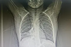 9岁男童气道险被堵死！医生提醒，近期连发5起，家长要留心图片