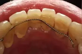 牙齿松动怎么办？有一种方式让它稳稳当当图片