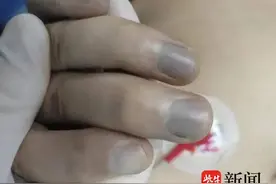 调味包过期导致亚硝酸盐中毒，一袋方便面差点要了她的命图片