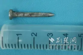 工人头部遭气枪钢钉射中当场昏迷 医生紧急取钉保住大脑功能图片