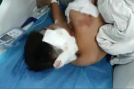 被狗咬伤的10岁男童，最新消息！看着揪心图片