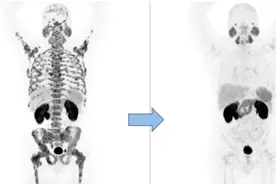 像“制导导弹”一样瞄准癌细胞！核药物来了图片