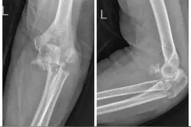 日照市中医医院成功救治一位肘关节粉碎性骨折老年患者图片