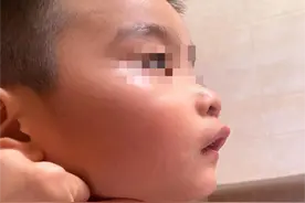 健康小站 | 孩子张口呼吸，睡觉打鼾？除了越长越丑，还可能是病图片