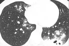 咳一周查出肺里好多洞！30岁女子中招“隐形杀手”，死亡率高达80%！图片
