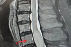 右下肢麻木半年，竟是胸椎椎管内长了肿物图片