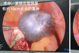 家有女孩必看！15 岁女孩腹痛牵出720°卵巢蒂扭转图片