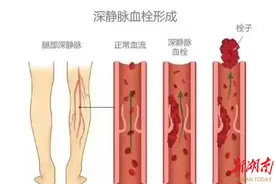 世界血栓日|动起来，别让血栓危害你图片