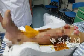 男子翻车摔伤后险些截肢 当心触发“骨筋膜室综合征”图片