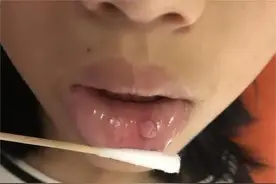 你家孩子还在频繁咬嘴唇吗？6岁女孩因这个习惯上了手术台图片