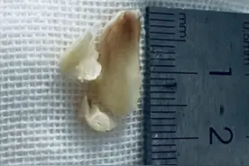 七旬婆婆气管呛入2cm锋利鱼骨，医生内镜下成功取出图片