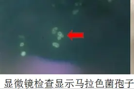 15岁少年前胸后背长痘，当心这种皮肤病图片