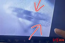 女子一根睫毛上长了6只螨虫，双眼红肿干痒视力模糊，医生紧急提醒图片