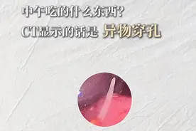 知名主持人误吞鱼刺紧急手术！年末聚会多，那些“土方法”别再用了图片