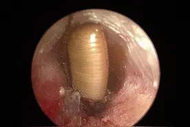 广东女子睡梦中有虫子爬进耳道！医生提醒→图片