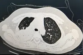 高烧4天，7岁娃查出“白”肺！多地出现就诊高峰！医生提醒→图片