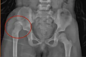 40秒，医生复位“熊孩子”大胯脱位！春节期间，青岛妇儿医院共接诊救治363 起意外伤害图片