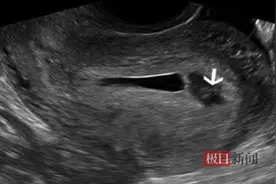 孕妈腹胀就医竟是先兆流产，竟和这个行为有关，医生紧急提醒！图片